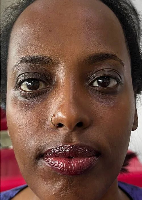 Eyebag Correction Before & After