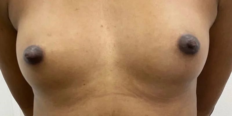 Breast Enhancement Before & After