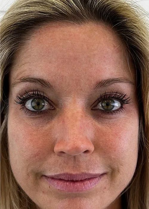 Hydrafacial Before & After