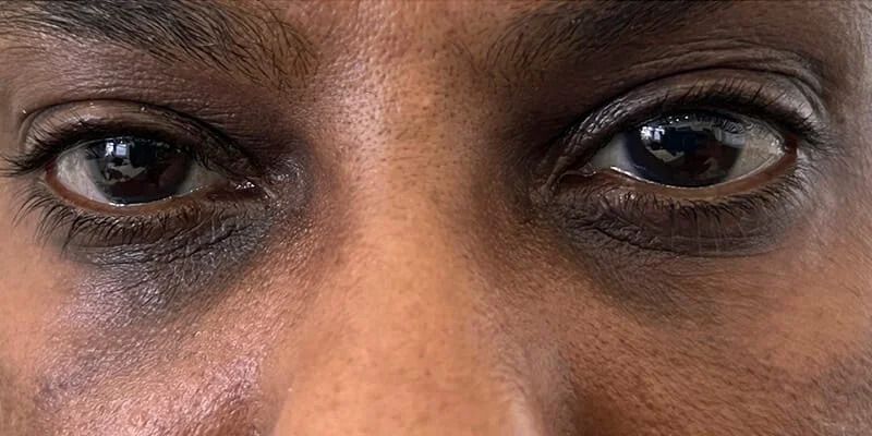 Dark Circle Treatment Before & After