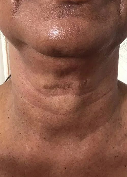 Non Surgical Necklift Before & After