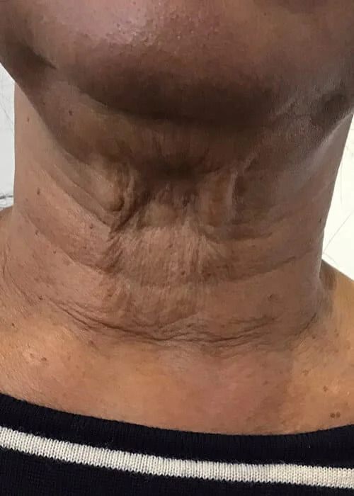 Non Surgical Necklift Before & After