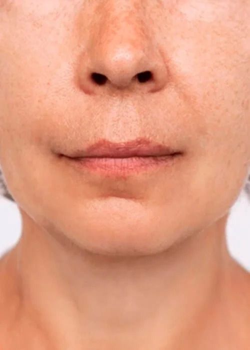 Non Surgical Necklift Before & After