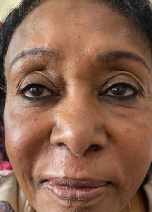 Liquid Facelift Before & After