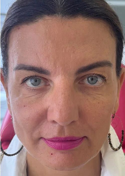 Marionette Lines Before & After