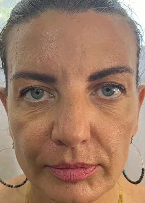 Marionette Lines Before & After