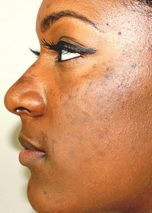 Hyperpigmentation Treatment in Nairobi